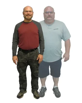 Bariatric patient before and after weight loss