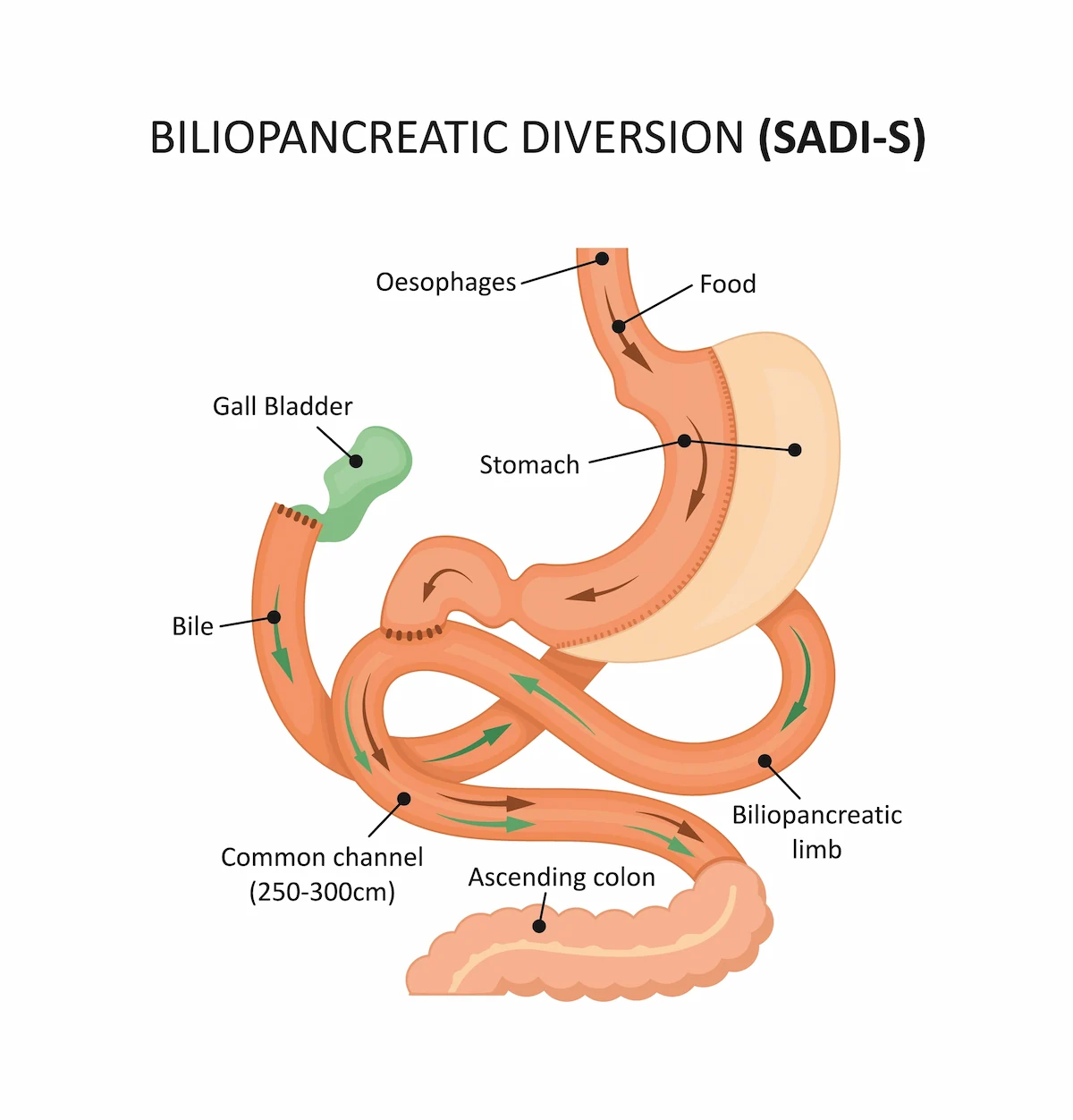 Graphic depicting the SADI-S procedure